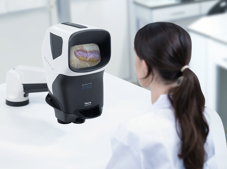 Mantis Pixo – Hair Transplant – Image4 – 768x572px Mantis Elite Cam HD with monitor showing air follicle magnified